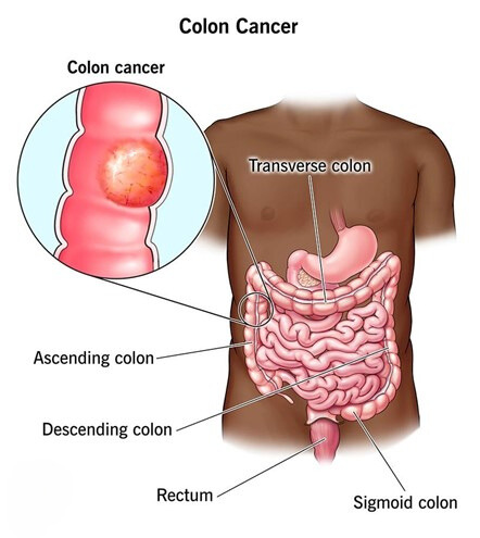 colon cancer