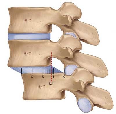 Lumbar Spondylolisthesis