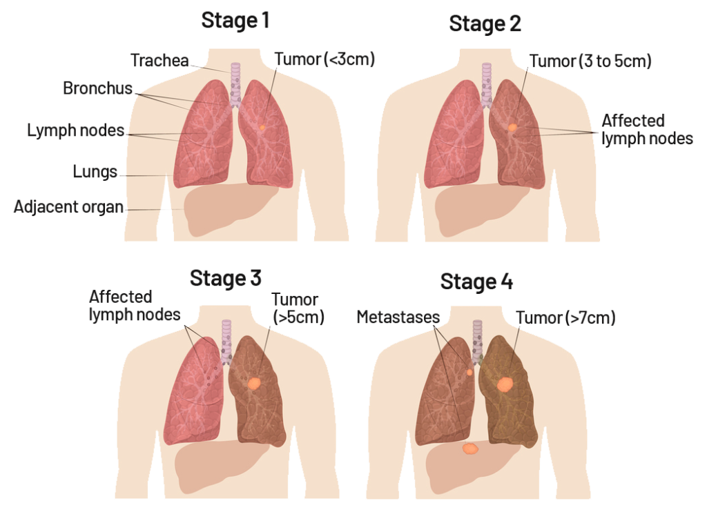 lung cancer stages