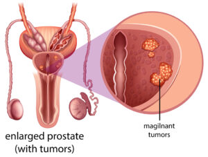 Male Prostate Cancer diagram