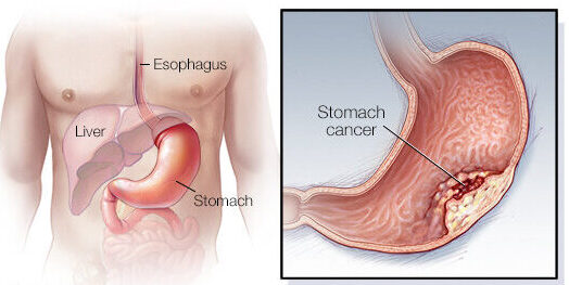 stomach cancer