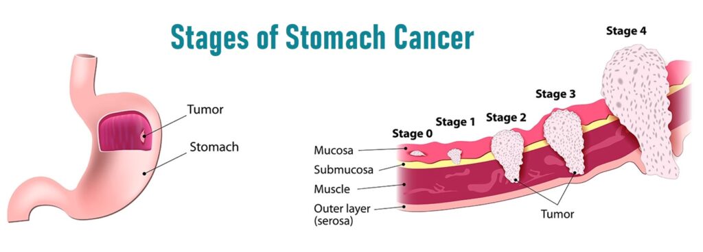 stomach cancer stages