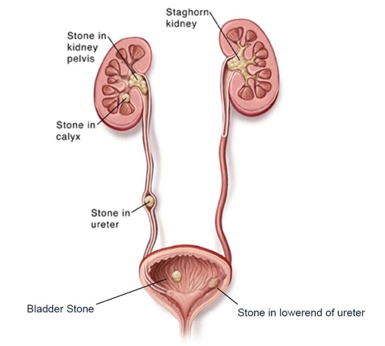 Ureteric Stones