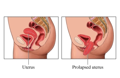 Uterine Prolapse Repair procedures to address the descent or sagging of the uterus into the vaginal canal. Cystocele (Bladder Prolapse) Surgical interventions to restore the position of the bladder and alleviate symptoms such as urinary incontinence. Rectocele (Rectal Prolapse) Uterine Prolapse Repair