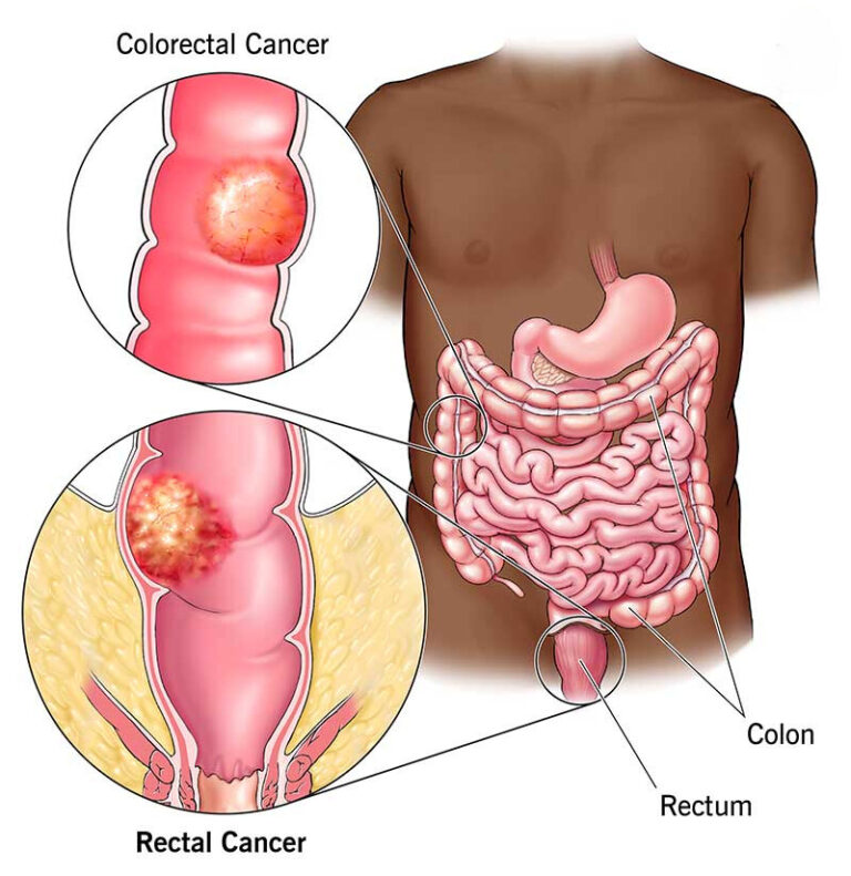 Rectal Cancer Surgery