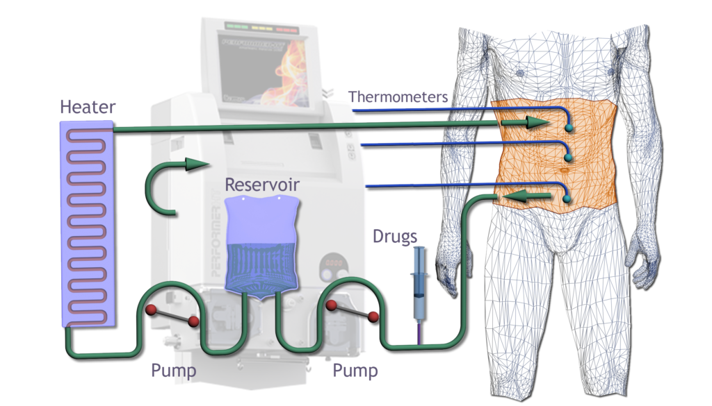 Debulking Surgery and HIPEC