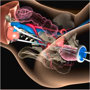 Natural Orifice Surgery