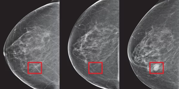 Breast Cancer mamography